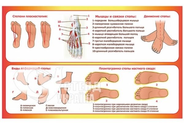 Стенд «Плоскостопість»